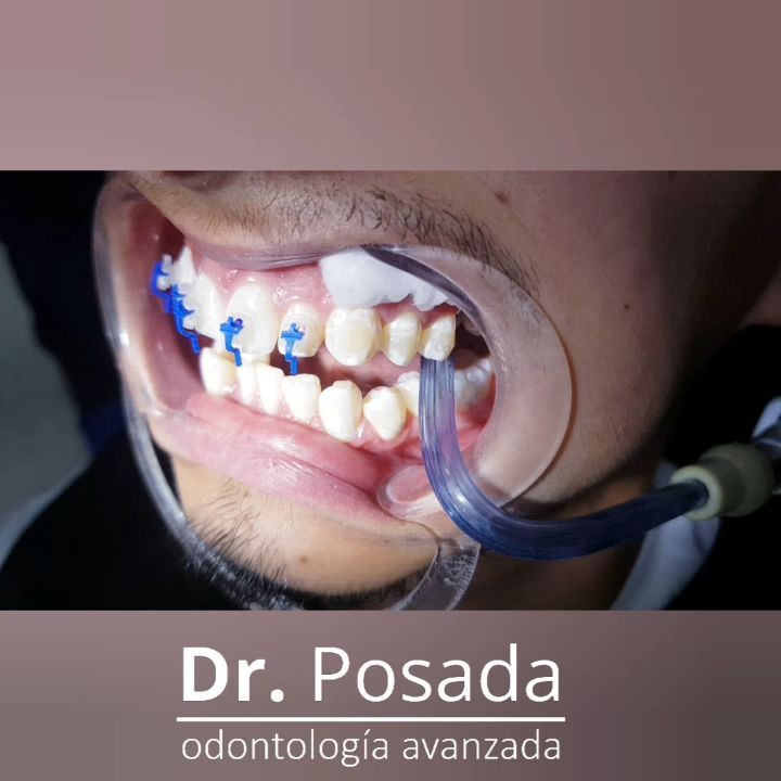 💫💫Que comience la #magia 💫💫con los #bracketsautoligadoclear. Son una excelente alternativa al momento de iniciar tu tratamiento de #ortodoncia en la clínica @dr.posada Son libres de elásticos, discretos, cómodos, tienen una menor fricción y el tratamiento será más corto ya que es uno de los métodos más eficaces.
Pregunta por nuestras #promociones y no olvides agendar tu cita para más información (link del whatsaap en la bio) 📲📲 +57 3046529022 ☎️☎️ 6017552046
.
.
.
.
.
.
.
.
.
.
.
.
.
.
.
.
.
.
.
#bracketsesteticos #braces #odontologiadecalidad #bracketautoligado #bracketsautoligados #brackets #bracket #ortodoncista #bracketssmile #bogota🇨🇴 #bracketsbogota #ofertas #losmejores #sabado #bracketscomodos #damon #bracketsdamon