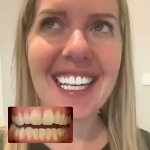 Klinik Tandblekning 
ERBJUDANDE 1490 KR (Ordinarie pris 4900 kr)
ONLINE TIDSBOKNING
www.DentalClinicSweden.com 🔺️ BOKA FÖR 2 PERSONER & FÅ YTTLIGARE 200 KR RABATT!
 #tandblekningstockholm #TandblekningStockholm #KlinikTandblekning #TandblekningGöteborg #TandblekningUppsala #TandblekningUtbildning #TandblekningsUtbildning