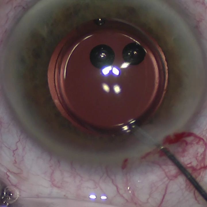 Usually it's the other way round: IOL exhange - replacing at 4 months post-op a monofocal IOL causing negative dysphotopsia with a Trifocal IOL. #lovemyjob #trifocaliol #iolexchange #iolscaffold