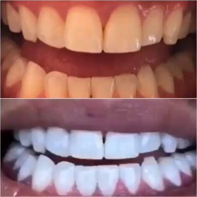 Klinik Tandblekning 
ERBJUDANDE 1490 KR (Ordinarie pris 4900 kr)
ONLINE TIDSBOKNING
www.DentalClinicSweden.com 🔺️ BOKA FÖR 2 PERSONER & FÅ YTTLIGARE 200 KR RABATT!
 #tandblekningstockholm #TandblekningStockholm #KlinikTandblekning #TandblekningGöteborg #TandblekningUppsala #TandblekningUtbildning #TandblekningsUtbildning