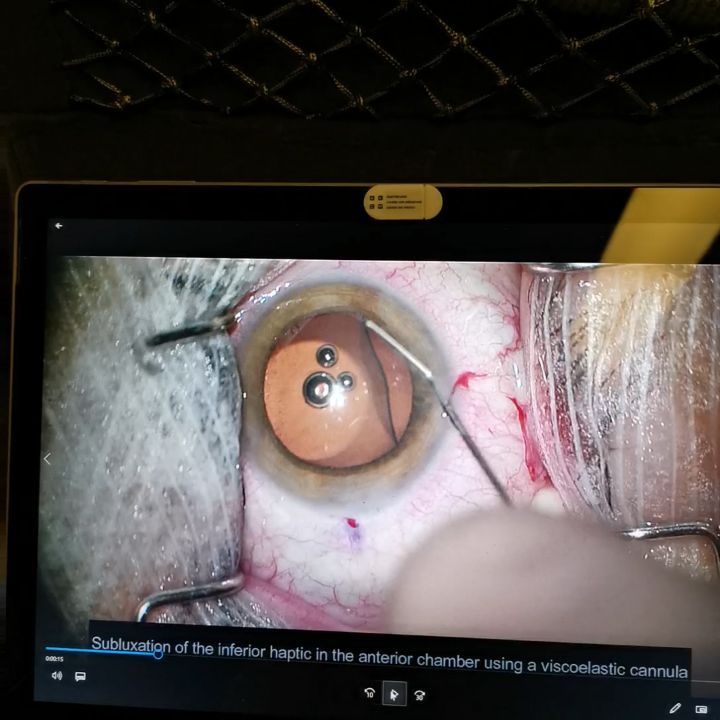 #videoediting #ICL #ICLvault #lowvault #tgv #eyesurgery #myopia #iclnoproblem