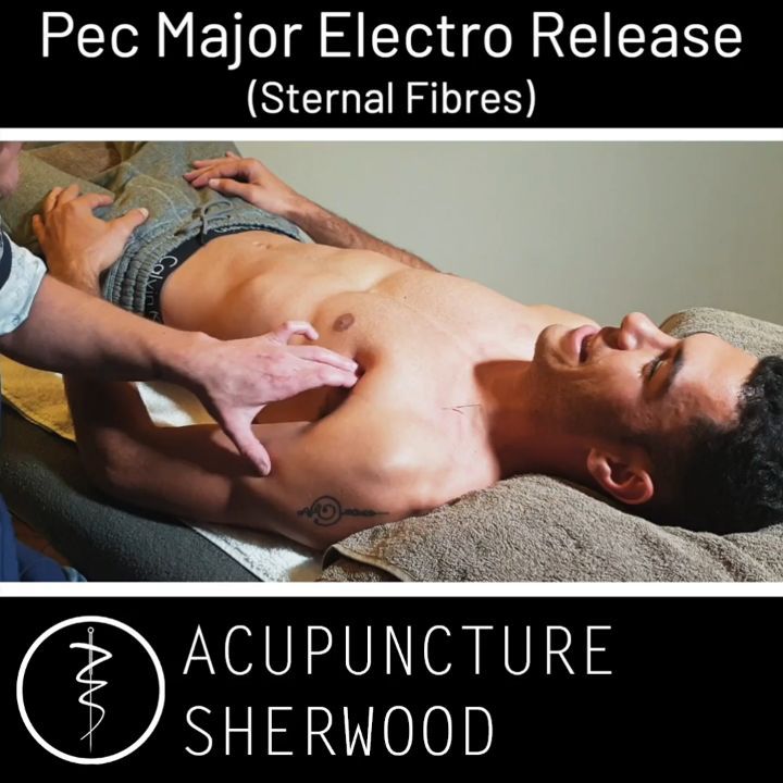 #acupuncture #acupuncturetreatment #acupuncturelife #acupuncturetherapy #acupuncturedoctor #acupunctureworks #acupuncturerocks #acupuncturebrisbane #muscle #muscletightness #activation #repair #pec #pecmajor