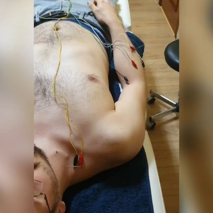 Aquí traemos un nuevo caso práctico de algunas lesiones que trabajamos en consulta.
Hoy toca un ejemplo de NEUROPATÍA DEL NERVIO RADIAL.
En este video vemos como trabaja nuestro cliente y amigo @gabrieltorner para poner solución a una lesión relacionada con su trabajo (músico).
Llega a consulta con:
⛔ Dolor/discomfort en la musculatura extensora de la mano y muñeca ("EPICONDILITIS").
⛔ Sensaciones de FATIGA, HORMIGUEO OCASIONAL E INCHAZÓN.
⛔ Falta de fuerza, al realizar un esfuerzo aparece un claro "TEMBLEQUE MUSCULAR/fasciculación".
⛔ Dolor que se ha producido de forma frecuente a nivel CERVICAL.
Al final todo esto se traduce en una disminución de su CAPACIDAD DE TRABAJO‼️
El tratamiento elegido para estas 2️⃣ SESIONES realizadas ha sido principalmente:
✅ Neuromodulación del nervio radial en todo su trayecto (cervical y musculatura extensora de mano y muñeca) ➡️ ESTIMULAR EL NERVIO ELECTRICAMENTE PARA INFLUIR EN LA FORMA EN LA QUE TRABAJA
✅ Electroestimulación para ayudar a la RECLUTACIÓN de fibras musculares ➡️ Ayudar a mejorar su movimiento y su fuerza
✅ Trabajo de fuerza mediante ejercicios selectivos para trabajar CERVICALES Y EXTENSORES.
En tan solo 2️⃣ SESIONES ha notado una BUENA MEJORA en cuanto a la capacidad de tolerar esfuerzos, fuerza y disminución del dolor y discomfort comentados‼️
No es mágia, es un TRABAJO INDIVIDUALIZADO y ADECUADO a SUS NECESIDADES junto con SU VOLUNTAD Y TRABAJO EN CASA.
FELICIDADES AMIGO, ERES UN FUERA DE SERIE @gabrieltorner.
Felices fiestas a tod@s, aquí estaré para resolver VUESTRAS DUDAS y AYUDAROS (si queréis)🎅🌲.
#fisioterapia #dolor #neuropatía #rehabilitación #nervio #fuerza #trabajo #recuperacion #musica #musico #clasica #fisio #electroestimulacion #neuromodulacion #compex #dosrius #canyamars #canmassuet #llinarsdelvalles #mataro #granollers #cardedeu