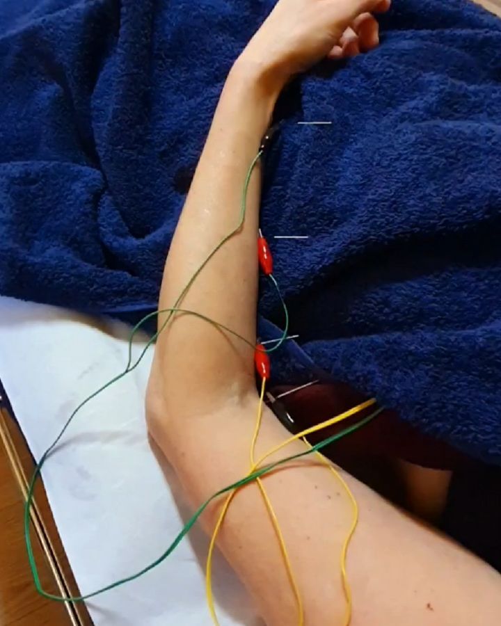 ¿Qué puedes hacer si tienes dolor por una patología como el síndrome del túnel carpiano?
¿Te vas a cirugía directamente o intentas solucionarlo sin pasar por quirófano?
⚠️ La realidad es que la mayoría de casos optan por ir a cirugía directamente, pensando que no hay alternativa y en varias ocasiones, sin encontrar en esa operación la solución total a su problema.
Pero, ¿Por qué puede pasar eso?
📝 Pues en realidad el nervio afectado no pasa solo por la muñeca, sinó que en realidad se origina en las cervicales y pasa de ahi a través del hombro, hasta la mano. En ese trayecto puede quedar atrapado en diferentes puntos, no sólo en la muñeca. Por ese motivo puede ser que una cirugía no acabe de solucionar tu problema y por ese mismo motivo, acudir a un fisioterapeuta que sepa abordar ese problema te puede ayudar.
Y tú, ¿Eres de ir directamente al quirófano sin buscar otras soluciones o prefieres probar antes otros tratamientos? 🤔
#fisioterapia #dolor #neurologia #neuropatia #traumatologia #tunelcarpiano #sindrome #nervio #neuropatia #cervicalgia #cervicales #atrapamiento #fisioinvasiva #fisio #traumatologia #cirugia #neuromodulacion