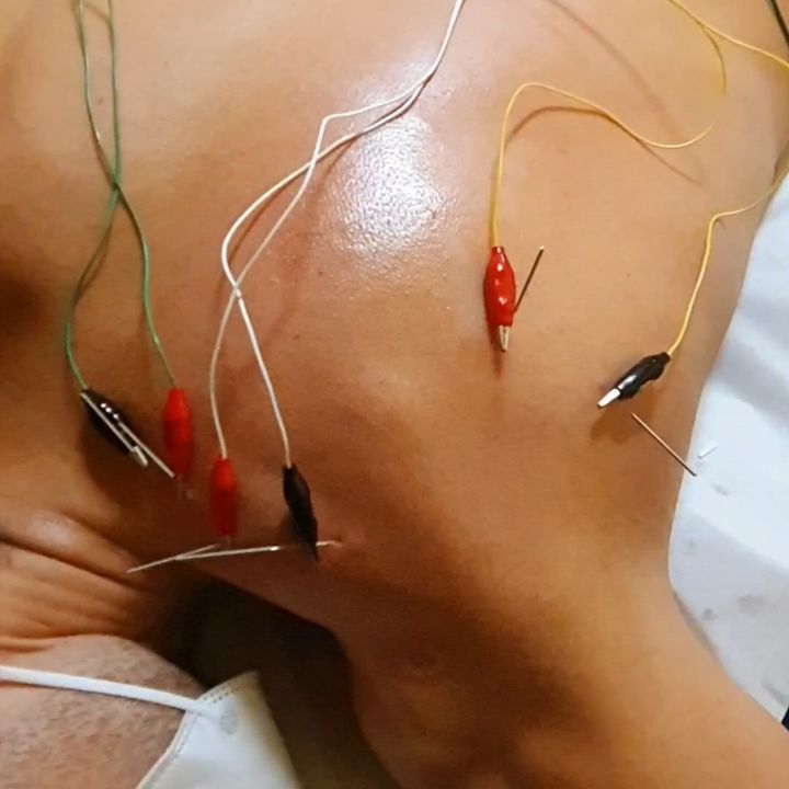 Tratamiento a un crack de talla mundial como es el gran @pauribes_sincro 🏊♂️🇪🇦
En este caso nos hemos centrado en tratar su hombro (manguito rotador) para acabar con unas molestias que tenía.
Es y será un placer ayudar a amigos tan increíbles como tu‼️
Mucha suerte en todo lo que esta por venir, si nos necesitas ya sabes donde encontrarnos 😉
#sincronizada #natacionsincronizada #natacion #atleta #españa #dolor #hombros #neuromodulacion #espalda ##fisioterapia #fisioterapiadeportiva #deporte #rehabilitación #readaptacion