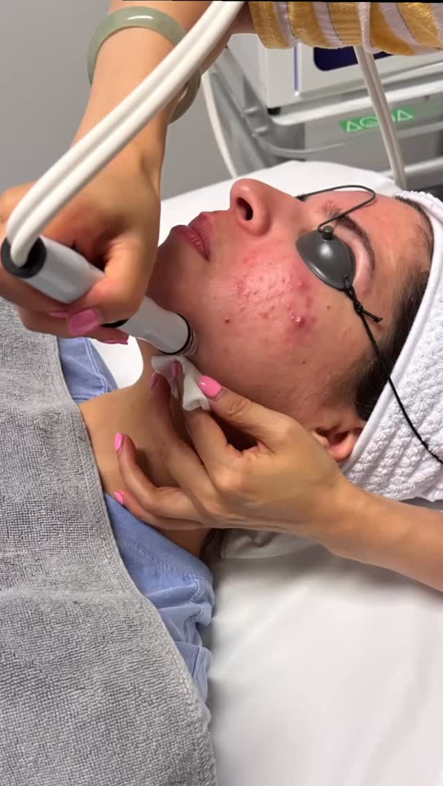 Severe acne treatment: aquapeel + Ipl treatment