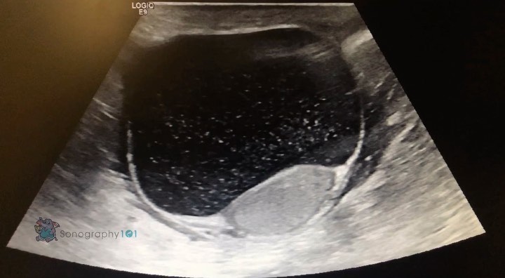 Hey guys, it’s snowing ❄️😅 Here’s a large spermatocele! .
.
*Correction from previous post, thank you to @_maham.n_ & @adaffodilforyou for catching the typo. 🤗