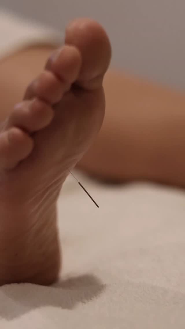 KID-1 is located at the bottom of the foot and is the body's direct connection to the earth. From the perspective of TCM, it may therefore be an important point to help one feel more grounded. The Kidney energy in TCM is connected to our vital force, the fire within us that drives pretty much everything. From day to day energy to memory and reproductive health, the Kidney organ and channel in TCM plays a role.
This point can be needled, but often we will use acupressure or moxibustion on the point too, especially if people aren't comfortable with the idea of having a needle at the bottom of the foot!
#acupuncturepoints #acupuncture #KID1 #channeltheory #acupressure #acupunctureclinicbrisbane #acupuncturistsofinstagram #acupuncturistsofbrisbane #tcm #chinesemedicine