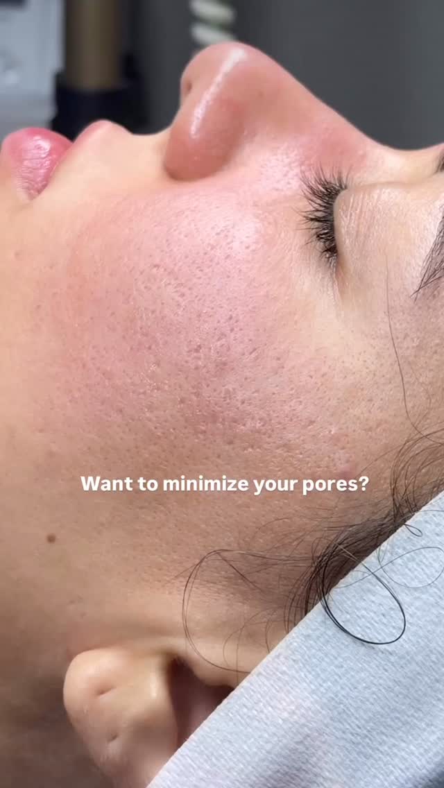 ✨ Repair Your Summer Skin ✨
Sun, heat, and outdoor fun can leave your skin feeling tired and damaged. Now is the perfect time to restore your glow!
Special Offer: Microchanneling Package
💎3 Sessions for the Price of 2💎
Smooth texture, lighten spots, boost collagen