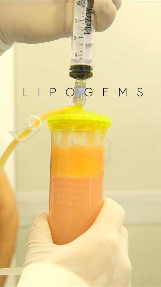 Será que a prótese de joelho é a sua única alternativa?
Conheça o Lipogems, procedimento que a equipe do Joelho no Esporte foi pioneira em Criciúma e região.