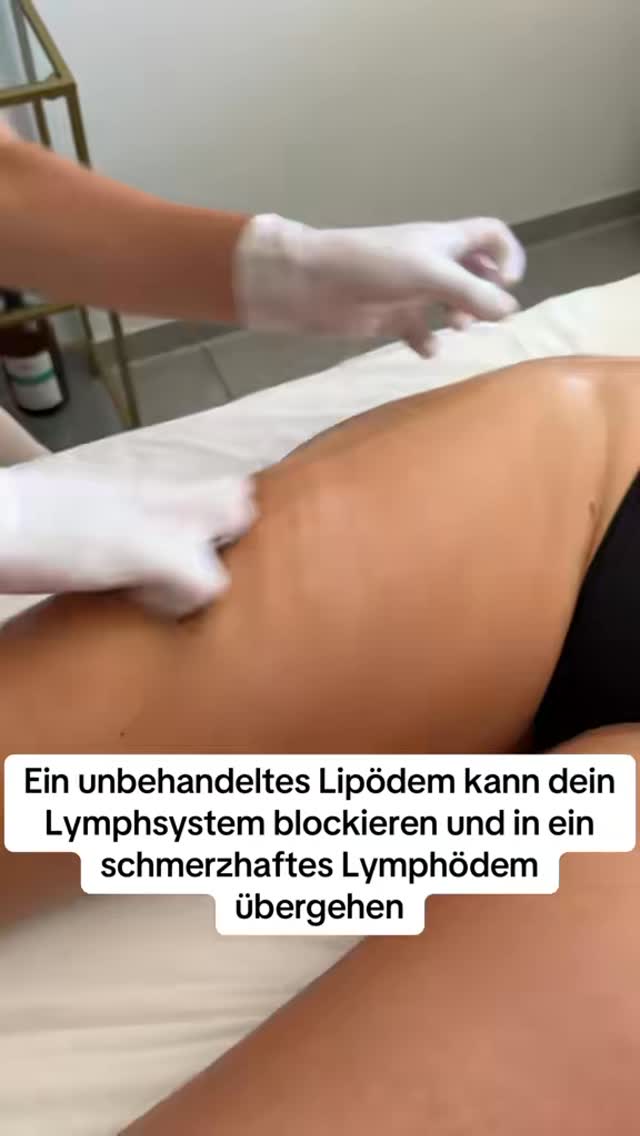 Das Lymphsystem ist eines der wichtigsten Reinigungssysteme unseres Körpers es transportiert Giftstoffe, überschüssige Flüssigkeit und Abfallstoffe ab, stärkt gleichzeitig unser Immunsystem und sorgt dafür, dass wir uns vital und gesund fühlen.
Wenn das Lymphsystem blockiert ist oder nicht richtig arbeitet, fühlen wir uns oft müde, schwer und aufgebläht. Genau hier setzt die Madero-Therapie an: Durch spezielle Massagetechniken mit Holz-Werkzeugen wird das Lymphsystem aktiviert, die Durchblutung angeregt und der Stoffwechsel in Schwung gebracht.
Die Wirkung ist tiefgreifend: Der Körper wird entlastet, Wasseransammlungen und Schlackenstoffe werden abtransportiert, und gleichzeitig formt sich die Silhouette sichtbar. Dabei geht es nicht nur um äußere Schönheit, sondern vor allem um Gesundheit und ein starkes Immunsystem.
Die Madero-Therapie ist also viel mehr als eine Massage – sie ist ein ganzheitlicher Ansatz, der den Körper reinigt, regeneriert und neue Energie schenkt. 🌱✨
#maderotherapie #lipödem #wassereinlagerungen #massage #münchen