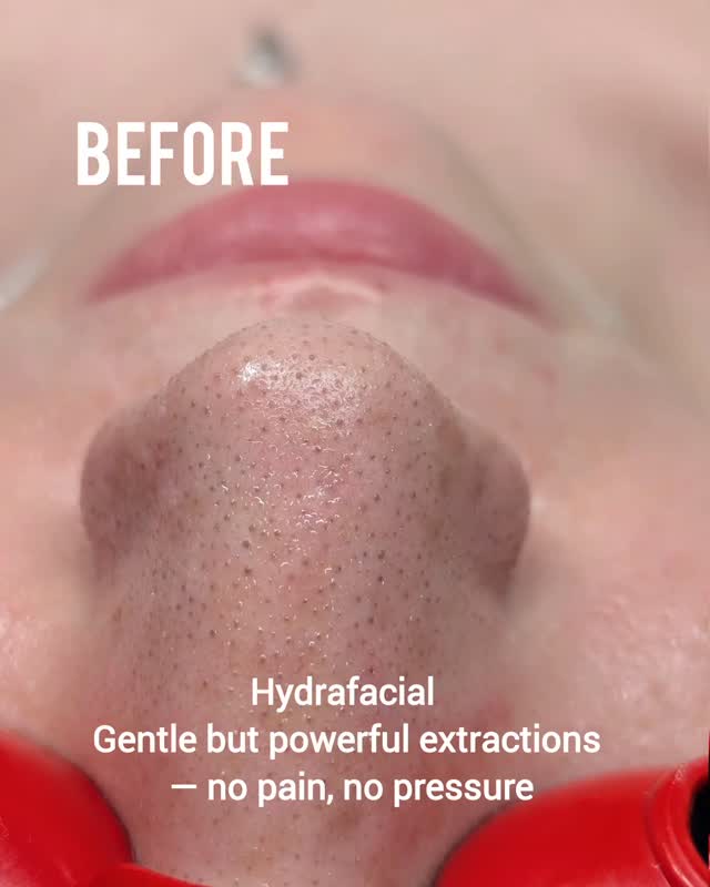 Hydrafacial works deep to unclog pores, remove impurities, and leave your skin glowing instantly. 🌟
Ready for smooth, fresh skin without discomfort?
Book your Hydrafacial today 🔗lno.care
🔗 in bio
#Hydrafacial #GlowingSkin #FacialCare #ClearSkinJourney #NoPainJustGain
#lno_boutique