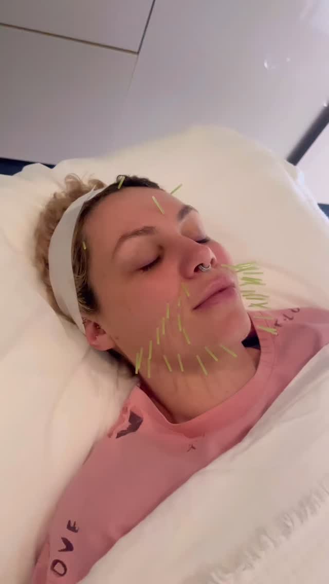 Acne isn’t just a skin-deep issue. It’s connected to what’s happening internally. Acupuncture works by recalibrating your systems and addressing the root causes behind inflammation, breakouts, and sluggish skin repair.
➡️ Hormone balance
Body acupuncture points help regulate the hypothalamic-pituitary-adrenal (HPA) axis and reproductive hormones. By calming cortisol, regulating androgens and supporting overall hormone balance, acupuncture can reduce one of the key drivers of persistent acne.
➡️ Nervous system reset
Acupuncture activates the parasympathetic “rest and digest” response. This is essential for repair, reducing stress-driven breakouts, and supporting deeper, more restorative sleep.
➡️ Gut health and detoxification
By influencing the vagus nerve and gut motility, acupuncture helps improve digestion, clear bacterial overgrowths through immune activation, and regulate bowel movements. This supports bile production and liver detox pathways, which are crucial for processing hormones and reducing systemic inflammation.
The lymphatic system also benefits, improving circulation and clearance of waste products that can otherwise show up as congestion in the skin.
➡️ Local effects on the skin
Cosmetic acupuncture on the face increases microcirculation, oxygen delivery, and collagen production. This helps to repair tissue, reduce redness, and smooth scarring.
💬Research shows acupuncture can reduce systemic inflammation, regulate sebum production, and modulate the immune system, making it a powerful tool for stubborn skin concerns.
When body acupuncture for internal balance is combined with cosmetic acupuncture for local skin healing, acne is treated from the inside out.
#acupuncture #cosmeticacupuncture #acnehealing #acnetreatment #naturalskincare #holisticskincare #acnetips #chinesemedicine #skincarecommunity #acnejourney #clearskinjourney #acnetreatmentthatworks #holistichealth #skinconfidence #acnesupport