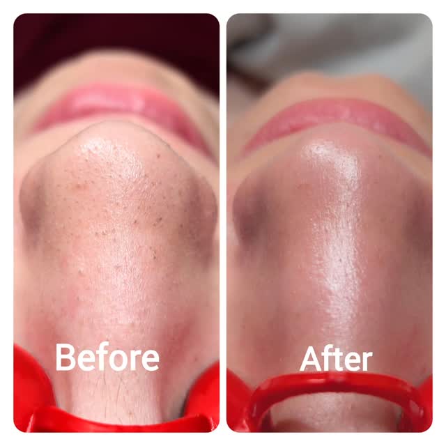 Hydrafacial Magic – Before & After
Say goodbye to clogged pores and dull skin, and hello to smooth, glowing, and deeply cleansed skin.
In just one session, pores look refined, the skin feels fresh, and that healthy glow is back! 💧
📍 At LNO Boutique, we believe facials should be effective and relaxing – and Hydrafacial gives you both.
#ColoradoSpa #ColoradoSkinCare #DenverSpa #DenverSkinCare #ColoradoBeauty #DenverBeauty #ColoradoFacialist #DenverFacialist #ColoradoAesthetics #DenverAesthetics #ColoradoGlow #DenverGlow #HighlandsRanchSpa #LittletonSpa #ColoradoWellness#lno_boutique