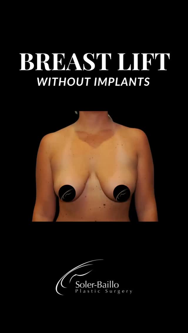 🪷 Breast Lift, No Implants
A breast lift reshapes and repositions the breasts for a more youthful, lifted contour. These before & after pictures show how we can restore natural proportions by addressing sagging and improving symmetry, all while enhancing confidence.
✅ No implants used
✅ Natural tissue reshaping
✅ Long-lasting, rejuvenated results
If you want a balanced, natural-looking outcome, come see us in Coral Gables!☀️
📱305-661-1996
💌 info@resultsmd.com
#breastlift #drsolerbaillo #plasticsurgerymiami #beforeandafter #mastopexy