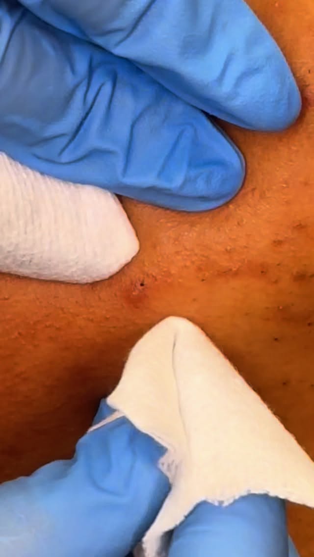 I thought it was a blackhead turned out to be a really long ingrown hair!
#blackhead #ingrown #pimple