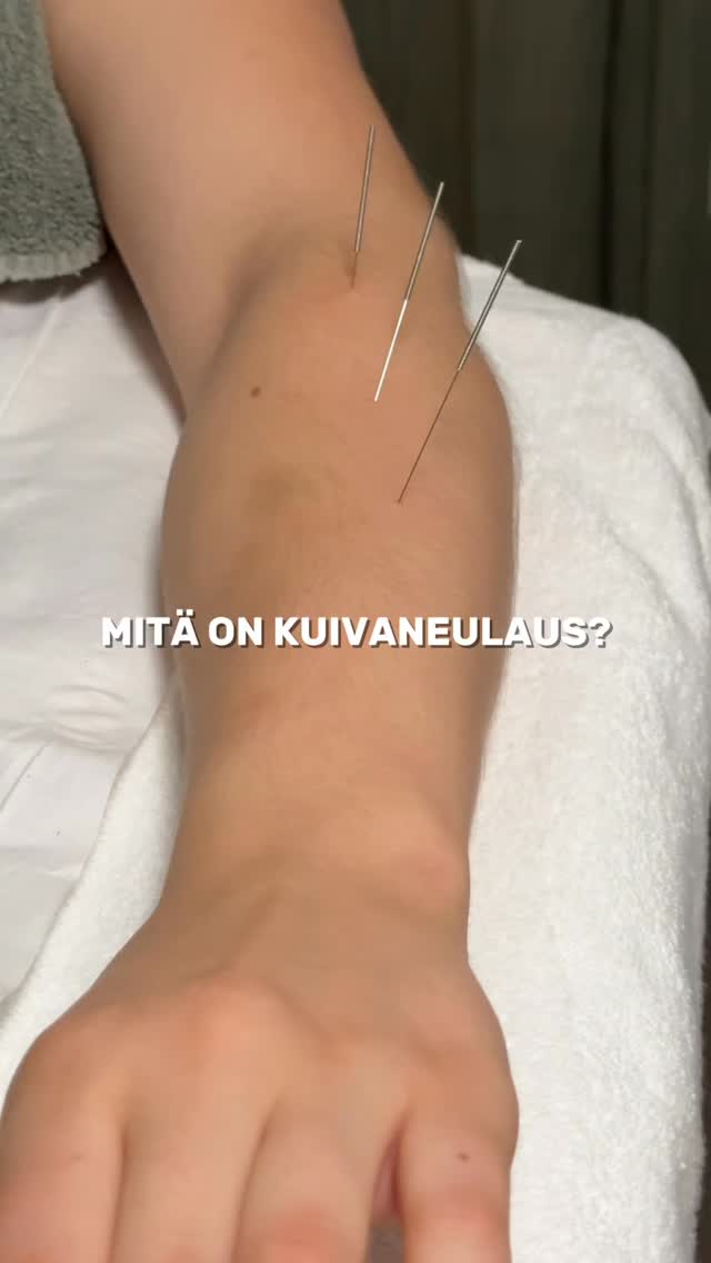 Mitä on kuivaneulaus?
Kuivaneulaus on länsimaiseen lääketieteeseen perustuvaa akupunktioneuloilla tehtävää hoitoa. Kuivaneulausta voidaan käyttää tarvittaessa naprapaattihoidon tai hieronnan yhteydessä lihasjännityksen ja kiputilojen lievittämiseen. Hoidon aikana ohut neula pistetään lihakseen muodostuneeseen triggerpisteeseen eli lyhentyneessä tilassa oleviin lihassyihin. Triggerpisteet tuntuu usein kipeänä ja arkana ”kyhmynä” lihaksessa. Neula stimuloi triggerpistettä sisältä päin ja aktivoi sen aineenvaihduntaa.
Kuivaneulaus on tehokas hoitomuoto erityisesti pitkään kestäneissä niska- ja hartiaseudun kiputiloissa. Kuivaneulasta voidaan käyttää myös tukena erilaisten rasitusperäisten vaivojen hoidossa kuten tenniskyynärpää tai juoksijanpolvi.
Kiinnostuitko? Varaa aikasi Lilianille hieronta + kuivaneulaukseen ajanvarauksen kautta! 🤩
#dryneedling #naprapathy #urheiluhieronta #naprawealth #ruoholahti #helsinki
