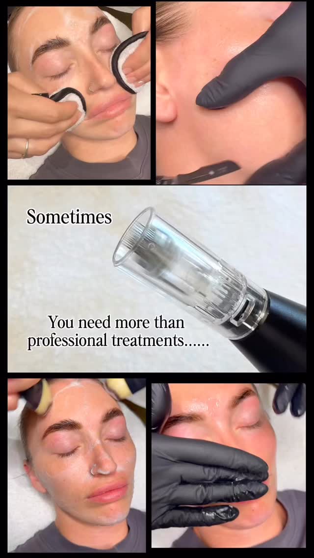 ✨ Clear skin starts from within! ✨
Professional skincare treatments and an
A⭐️homecare routine is a powerful combination — but did you know your gut and hormones play a huge role in your skin’s health?
Supporting your body with the right gut and hormonal supplements can help in so many ways:
🌿 Balance inflammation
🧬 Support hormone regulation
🦠 Strengthen the gut-skin connection
💧 Improve skin clarity, texture, and glow
🙌🏻Professional treatments treat the surface — supplements help heal the root cause.
Combine both for real, lasting results! 💫
#SkinHealth #HormonalBalance #GutHealth #InsideOutBeauty #SkincareJourney #skincare #glowingskin