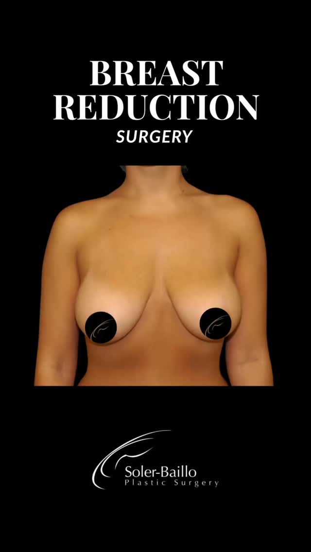 🌟 Considering a breast reduction? This transformative procedure not only enhances your proportions but can also relieve back, neck, and shoulder pain for improved comfort and confidence.
Dr. Soler-Baillo is a board-certified plastic surgeon who customizes every procedure to your body and goals, helping you achieve a lighter, balanced, and natural look. ✨
☎️ Interested? Contact us today at 305-661-1996 in beautiful Coral Gables☀️🌴
#drsolerbaillo #plasticsurgery #breastreduction #breastsurgery