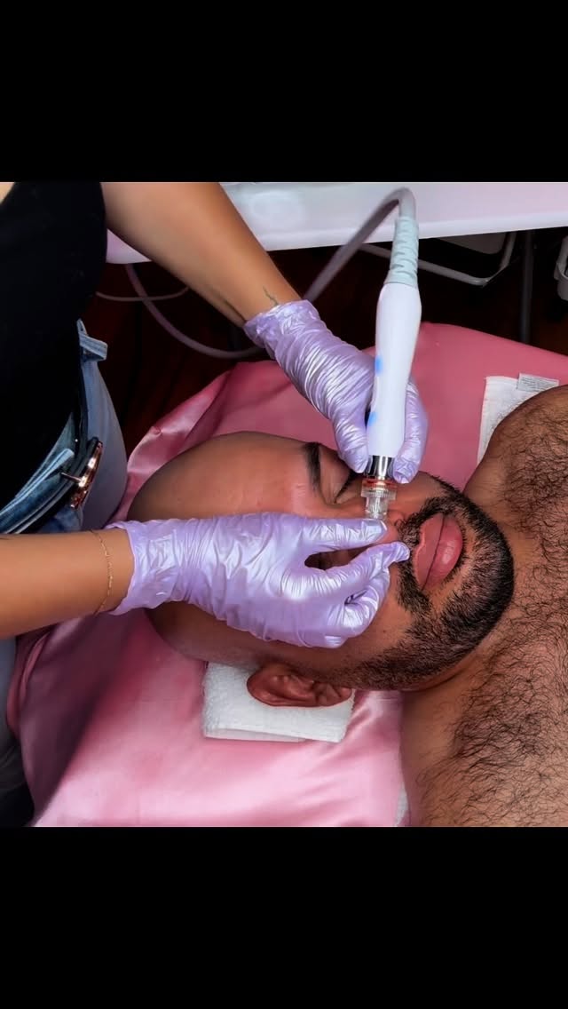 Hydrodermabrasion, or a hydro facial, is a popular skin care treatment that uses a machine to remove dead skin cells from your face and clear clogged pores. It can help improve skin texture, reduce fine lines and wrinkles, hydrate skin, and more. It’s also commonly used to treat mild acne scars and manage aging skin.