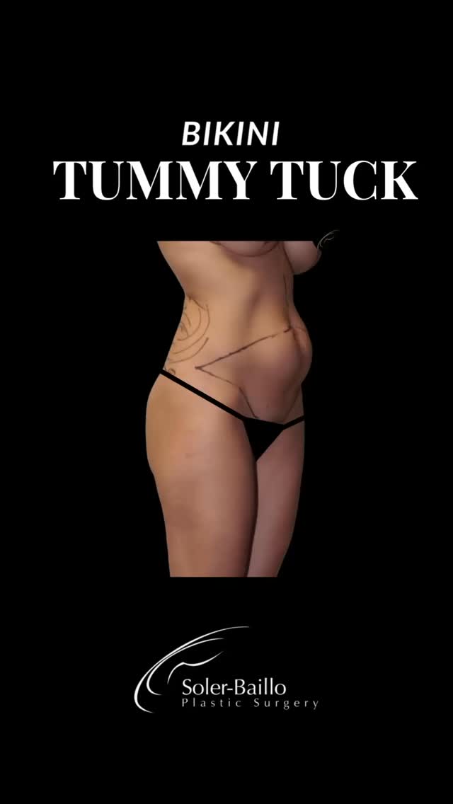 Goodbye stubborn belly, hello confidence 💫
Our Bikini Tummy Tuck™️ removes excess skin and tightens weakened abdominal muscles, restoring a smoother, firmer midsection. Results are tailored to each patient’s anatomy and goals.
Ideal for patients after pregnancy or significant weight loss. Is that you?
📳 Call now @ 305-661-1996
📍Soler-Baillo Plastic Surgery
#miamitummytuck #plasticsurgerymiami #tummytucksurgery #abdominoplasty #drsolerbaillo