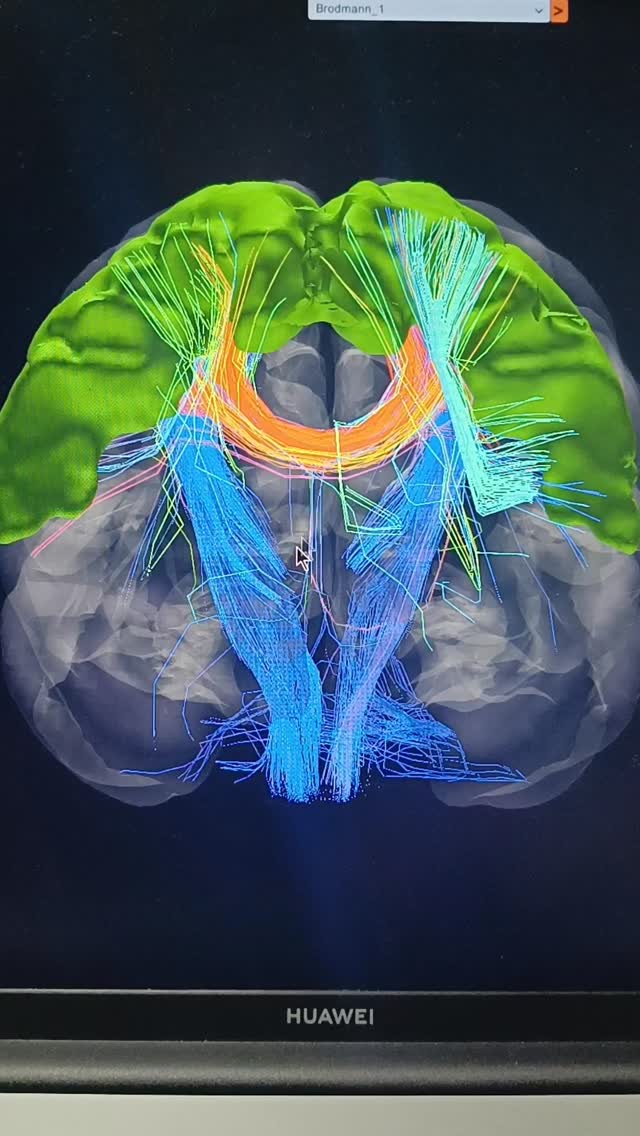 Planificando protocolo tratamiento con neurofeedback.