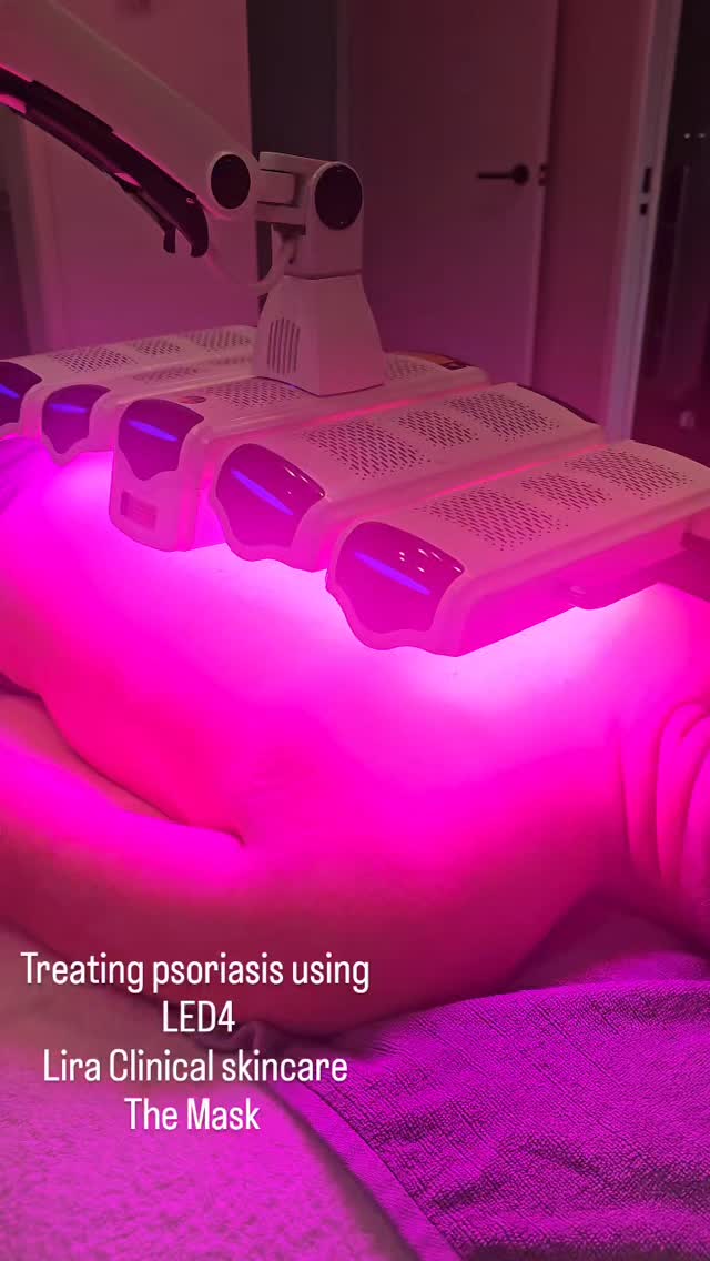 This client has had a FULL BODY flare up. He couldn't even shower as it hurt so bad. We have used @liraclinical for hone and in salon treatments and @themask_anz home device.
Beauty Oil and Health Balm is his savior, no burning and immediately calms the skin.
I cannot wait to see these results.
Stay tuned!!!
@dermal_supplies