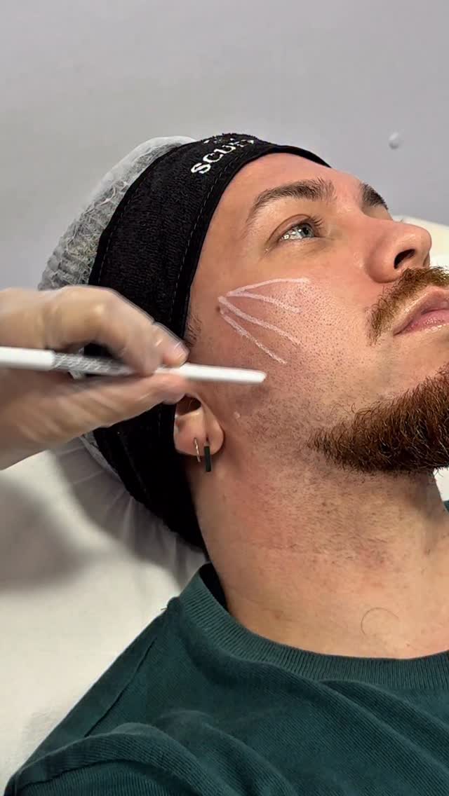 A convite da Galderma, iniciei minha harmonização facial na @procorpoestetica da Tijuca. Começamos com o bioestimulador de colágeno @sculptrabrasil e um preenchimento sútil nos lábios com @restylanebr 🖤🤍
Fiquem ligados! Em breve eu volto pra continuar a harmonização e mostrar tudo para vocês.
@fabianeemuniz #preenchimento #galderma #restylane #labios #preenchimentolabial #bioestimulador #bioestimuladoresdecolágeno #sculptra #harmonização