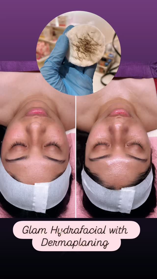 ✨ The Glam Hydrafacial ✨
Your skin’s new best friend 💕. This luxe treatment combines:
💎 Dermaplaning for the smoothest base
💧 HydraFacial + skin-specific booster to deeply cleanse, extract & infuse hydration
🌈 LED light therapy to calm & rejuvenate
The result? Instantly smoother, brighter, dewier skin with that ✨unreal glow✨.
📍 Glam Body Sugaring Boutique NYC
📅 Book now & glow with us!
#GlamHydrafacial #NYCSkincare #HydraFacialGlow #Dermaplaning #EstieBestie
