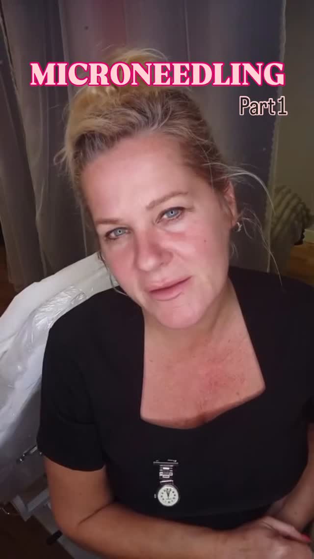 Microneedling ๐
Part 1โฆ. I want to bring some rejuvenation and life back to my skin so I will be doing some Microneedling on myself so you can see and follow along my journey. ๐งโโ๏ธ
I donโt believe in doing anything I wouldnโt do on myself and I really believe in the power of Microneedling!
Have you ever gotten this before? Drop a comment below and let me know if you love it as much as I doโฆ