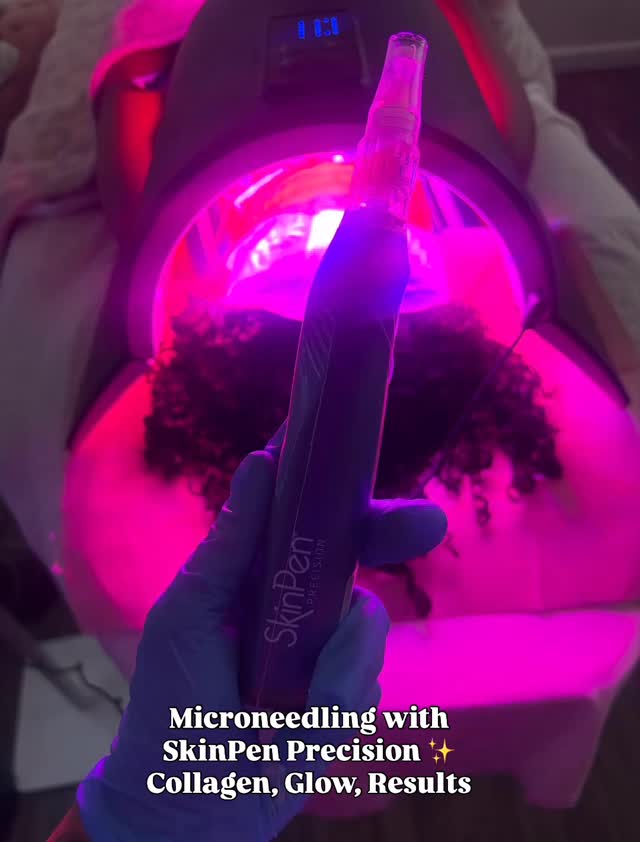 SkinPen Precision Microneedling: Everything You Need to Know ✨
🔬 What is microneedling?
Microneedling with the FDA-cleared SkinPen Precision creates thousands of controlled micro-channels in the skin. This jumpstarts your body’s natural healing response, stimulating new collagen + elastin production. The result? Smoother texture, smaller pores, softer fine lines, and even scar improvement.
🌟 Why SkinPen?
Not all devices are equal. SkinPen is the first FDA-cleared microneedling device, clinically proven for safety and results. It delivers consistent depth and precision—so you get noticeable improvements without the risks of old-school rollers or uncertified pens.
💡 The Science of the Glow
We’re not “damaging” the skin—we’re training it to heal smarter. Each treatment encourages your skin to regenerate healthier, firmer, and more radiant. Think of it like a workout for your skin 💪✨.
⏳ When will you see results?
You’ll notice a healthy glow within the first week, but collagen remodeling is a marathon, not a sprint. The real transformation happens around 3–6 months with a series of treatments—and results are long-lasting because we’re rebuilding your skin from within.
✨ Bonus: Pairing microneedling with LED light therapy boosts healing and maximizes your glow.
Are you ready to start your skin transformation journey? 💕
#Microneedling #SkinPen #CollagenInductionTherapy #GlowingSkin
#glambodysugaring #glendalequeens #ridgewoodqueens #bushwick #maspeth