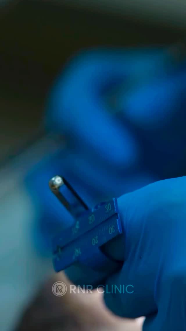 ✨ Lassen Sie sich von Ihrem Traumlächeln inspirieren!
Jetzt kostenlose Beratung sichern – inklusive individuellem Angebot! 💫
📍 In Istanbul bei RNR Clinic Turkey – Experten für ästhetische Zahnbehandlungen.
#rnrclinicturkey #dentalaesthetics #smilemakeover #zahnästhetik #hollywoodsmile #istanbulclinic #zahnbehandlung #perfectsmile #dentalcare #smiletransformations #fyp #dental #international #deutschland