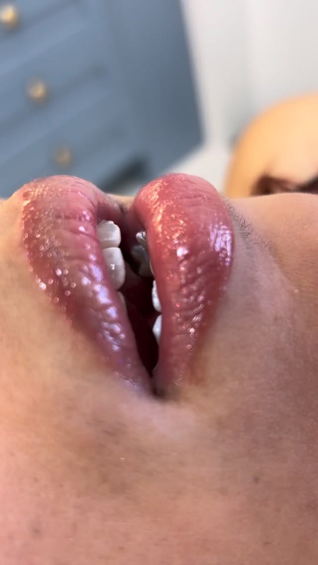 Pós tratamento ortodôntico pede um clareamento né!!!
Trazendo beleza e naturalidade.
Resultado excelente e paciente satisfeita. 😘
#clareamentoconsultório
#clareamentodental
#claudilenasantiago