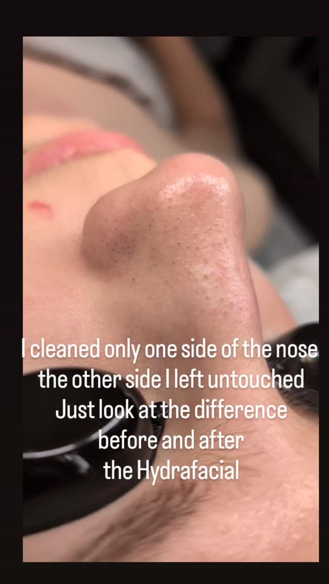 Can you see the difference? That’s the power of Hydrafacial!
This treatment deeply cleanses your pores, removes blackheads, and exfoliates dead skin — all while infusing your skin with nourishing serums. 🌿
It’s gentle, relaxing, and gives instant results: clean, hydrated, and glowing skin
Perfect for all skin types — even sensitive or acne-prone
#Hydrafacial #GlowingSkin #DeepCleansing #HydrationBoost #SkincareRoutine #BeforeAndAfter #HealthySkin #FacialGoals #LNOskinandnailcare