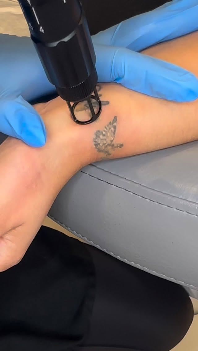 Laser tattoo removal ⚡️⚡️
#laser #lasertattooremoval #tattooremovallasvegas #lv