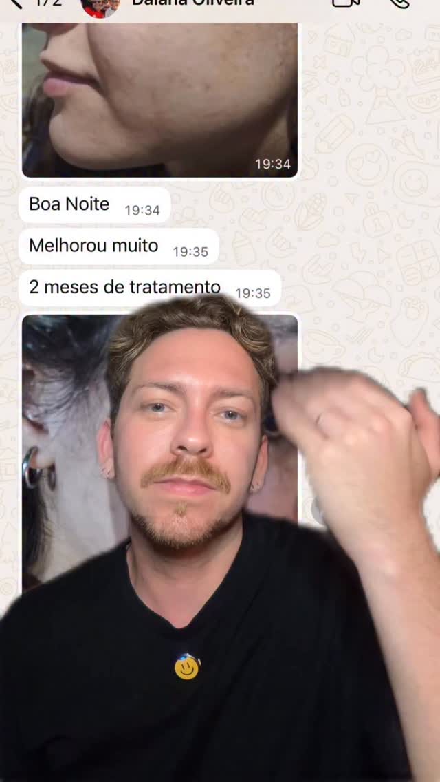 Olha esse com @principiaskincare 🖤🤍
Produtos usados:
- GL-02 (gel de limpeza)
- NC-10 (niacinamida)
- MIX-01 (mix de ativos)
- PM-10 (peptídeos)
- GH-01 (gel hidratante)
- PS-01 (protetor solar)
Cupom: JEFF10 ou JEFF5
#antesedepois #acne #principia #skincare #espinha #resultado #cupom