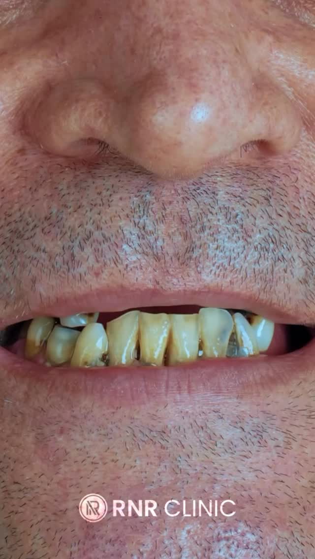 Lassen Sie sich von Ihrem Traumlächeln inspirieren!
Jetzt kostenlose Beratung sichern – inklusive individuellem Angebot! 💫
📍 In Istanbul bei RNR Clinic Turkey – Experten für ästhetische Zahnbehandlungen.
#rnrclinicturkey #dentalaesthetics #smilemakeover #zahnästhetik #hollywoodsmile #istanbulclinic #zahnbehandlung #perfectsmile #dentalcare #smiletransformations #fyp #dental #international #deutschland