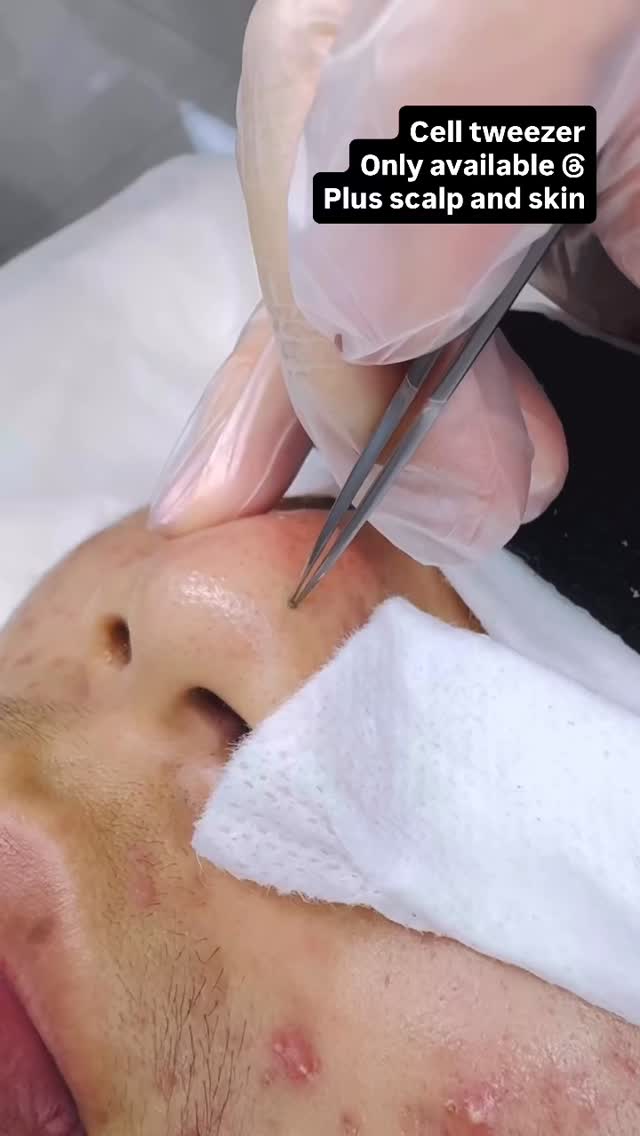 Tired of painful extractions? 💢
Say hi to Cell Tweezer — deep pore cleansing with zero pain, zero damage, and instant glow.
✨ Only at Plus Scalp and Skin
#malvern #melbourne #deepcleansing #pimple #blackhead #tweezer #acne #skincare #skintreatment #hydrafacial #chemicalpeels #extraction