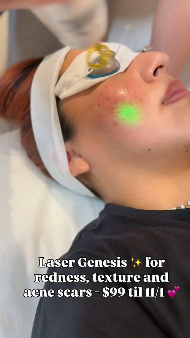 Redness? Texture? Acne scars? Laser Genesis said bye! 💅🏽✨
Our go-to glow treatment for real results — now just $99 until 11/1 💗
Text us to book this special! 347-930-3125
#glendalequeens #rosacea #astoriamoms #ridgewoodqueens
#GlamBodyQueens #LaserGenesis #GlassSkinGoals #QueensEsthetician #GlowTreatment