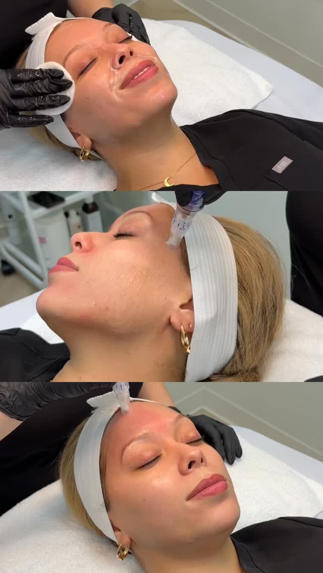Tiny needles, timeless glow ✨
Microneedling gently boosts collagen to smooth, brighten, and refresh your skin from the inside out because radiant skin never goes out of style 💕
#wheaton #naperville #glenellyn #glowup #libreaesthetics #medspa #microneedling #skinpen