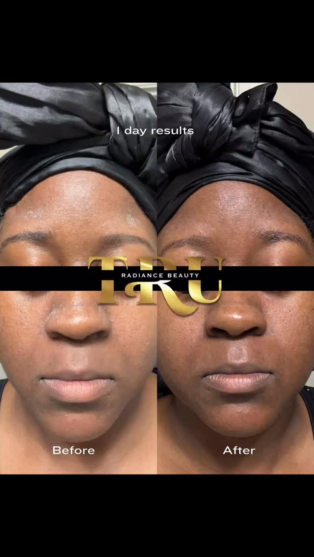 Woke up to my first product review 🥰🥰
I’m so happy people are already loving it and I know more people will ! Me being a girl with flaky, scaly sensitive skin due to my seborrheic dermatitis and knowing not a lot of people understand the struggles, I knew I needed to make sure people with similar issues felt seen. This harmony set is so good and helps with so many issues, acne, texture, anti aging, in the intimate areas, men can use it in the beards. The colder months are coming, I know people with eczema will love this as it calm your skin and irritation tremendously, I’m telling you !!
SHOP EVOLV
All face products is still 25% off right now ! Get yours
Truradiancebeauty.com
Free pick up & delivery available
#productreview #evolvtruradiancebeauty #cincinnatiesthetician #cincinnatiskincare #facialcare #seborrheicdermatitis #EczemaRelief #facialproducts