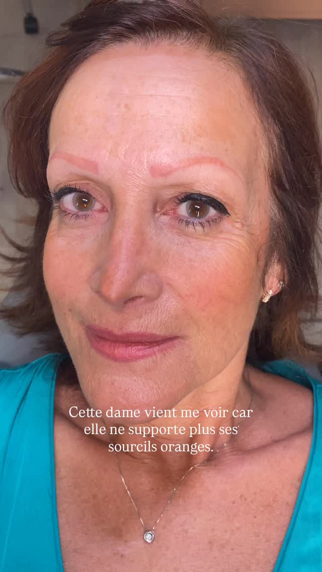 Déroulement d’une séance de correction sur un ancien maquillage permanent orange. Le laser n’est pas toujours la solution et dans ce cas, l’oxyde de fer présent dans le pigment minérale, rendrait le sourcil noir. J’opte pour un effet réaliste afin de sauver les sourcils de cette dame.
Deux séances sont nécessaires pour satisfaire le travail
Et toi, ajoute un commentaire si tu as des sourcils de ce type, ou tag, ta copine qui en a des aussi beau que cela. 🥰
#maquillagepermanent#sourcils#permanentsourcils