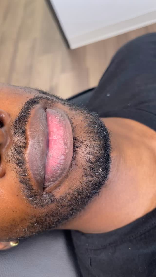 Vitiligo Camouflage is a Paramedical Tattoo that can conceal and even out hypopigmentation.
We are restoring confidence by building up ink pigments for permanent results. After 3-4 sessions our client will have the even lip hue that he desires.
“Enhancing Lives One Image At A Time” ™️
Book An Appointment OR Consultation Today www.beatandblade.com
Learn this technique and become a Paramedical Tattoo Artist @beatandbladeacademy.
BEAT & BLADE
📍Houston, TX
(832) 377-5677
info@beatandblade.com
www.beatandblade.com
#paramedicaltattoo #vitiligo #scarcamouflage #skincamouflage #liptattoo