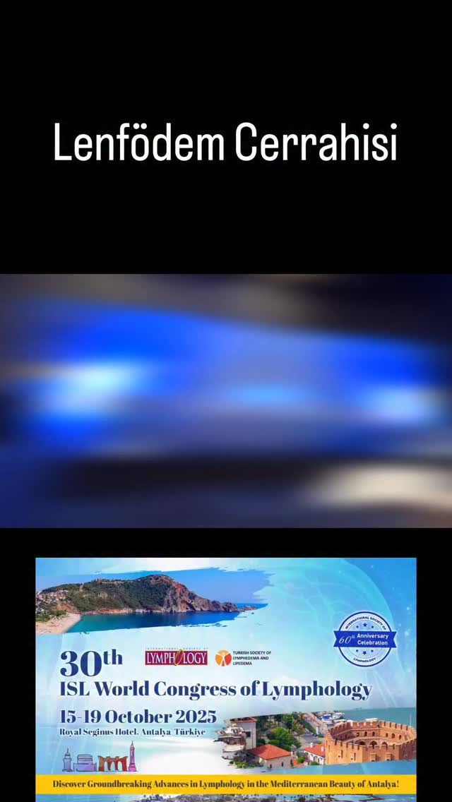 Dünya Lenfödem Kongresi / World Congress of Lymphology
Lenfödem mikrocerrahisi ve tedavisi
Lenfödem Cerrahisi
Lenfödem Hastalığı erken dönemlerden başlayarak cerrahi ile tedavi edilmesi gereken bir durumdur.
Lymphedema is a condition that requires surgical treatment starting from its early stages.
☎️+90 544 971 4801
Doçent Dr. TAHSİN OĞUZ ACARTÜRK
Plastik, Rekonstrüktif ve Estetik Cerrahi
@dr.oguzacarturk
#Lenfödem #filhastalığı #fizyoterapi #fizyoterapist #lipödem #lipedema #lymphedema #lva #plastikcerrahi #estetikcerrahi #izmir #istanbul #ankara #memekanseri #liposuction #mikrocerrahi #microsurgery #lenfödemcerrahisi #lenfödemterapisi #fiziktedaviverehabilitasyon
