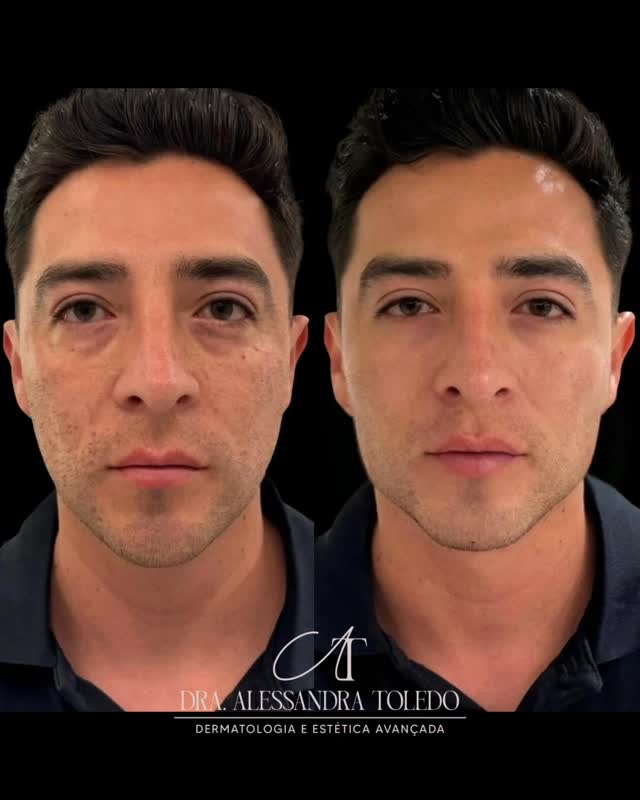 Você ainda acha que harmonização facial muda demais o rosto do homem? 👀
Então deslize para o lado 👉 e veja como o protocolo Face Up Masculino transforma sem tirar a naturalidade.
Nada de exagero.
Nada de rosto artificial.
Apenas traços mais definidos, olhar mais firme e um semblante de autoconfiança.
Porque o segredo não é parecer diferente — é parecer melhor.
⠀
📍Atendimento em São Paulo – Pinheiros
💬 Clique no link da bio e agende sua avaliação.
⠀
#FaceUpMasculino #HarmonizacaoFacialMasculina #DraAlessandraToledo #ResultadosNaturais #RostoMasculino #EsteticaAvancada #DermatologiaMasculina