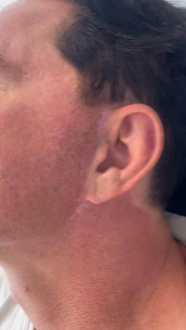 This is Paramedical Tattoo to camouflage a surgical scar. 2-3 sessions are needed for optimal and undetectable results.
Inquire Today!
(832) 377-5677
info@beatandblade.com
BEATANDBLADE.COM
#scarcamouflage #scarremoval #beforeandafter #transformation