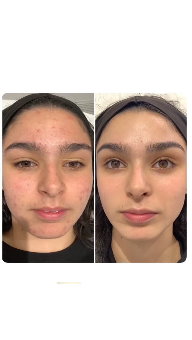 Problem skin? No worry’s.
We have helped thousands of clients with their skin journey. From problem skin to acne skin to hyperpigmentation and even hypersensitive.
We can help you too !
Get in touch to start your skin transformation today.
@theksclinic we are a multi award winning skin specialist of the year clinic 🏆 💫 with over 15 years in the industry.
#thekclinic #skinspecialist #birmingham #oldbury #london #manchester #problemskin #skinclinic #skincare #awardwinningclinic #facials #hydrafacial #polynucleotides #exosomes #skinpeels #beforeandafters #skintransformations #acneskincare @beautyfullawards