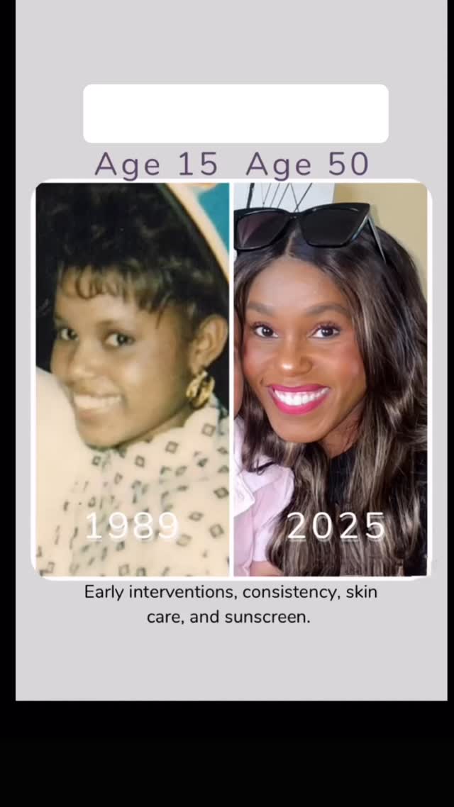 Looking for natural, refreshed results? Look no further than Handcrafted Aesthetics. Our goal is to help you look and feel renewed. Start your renewal journey today.#medspa #gahanna #botox #glowup #skinvive #juvederm #aesthetics #aestheticstyle