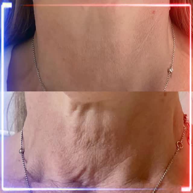 ✨ Real Results After Just ONE Sylfirm Treatment! ✨
Our Sylfirm Radiofrequency Microneedling treatment is changing the game — delivering smoother, tighter, and more radiant skin after just one session. 💫
This advanced technology works beneath the surface to stimulate collagen, reduce fine lines, fade pigmentation, and tighten skin — all with minimal downtime.
And the best part? 👉 It can be used all over the body! Whether it’s your face, neck, stomach, or thighs — Sylfirm helps rejuvenate and firm skin from head to toe.
Ready to see your own transformation?
📅 Book your consultation today and experience the Sylfirm difference.
#Sylfirm #RadiofrequencyMicroneedling #SkinTightening #CollagenBoost #GlowingSkin #BodyRejuvenation #SkinConfidence