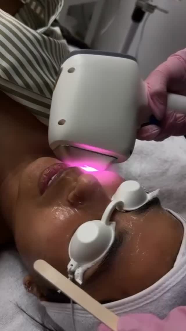 Glow up mode ON!
Say goodbye to dull skin and hello to a radiant, flawless complexion with our advanced face laser treatments.
#GlowSkin #LaserTreatment #RadiantSkin #SkincareGoals #HealthySkin #FlawlessGlow #SkinRejuvenation #GlowingSkin #DermatologyCare #SkinLove #surrey #hauteesthetics #delta #glowingskin #canada #selfcare #beautytreatment #skincaregoals #skincaregoals #antiaging #smoothskin #delta